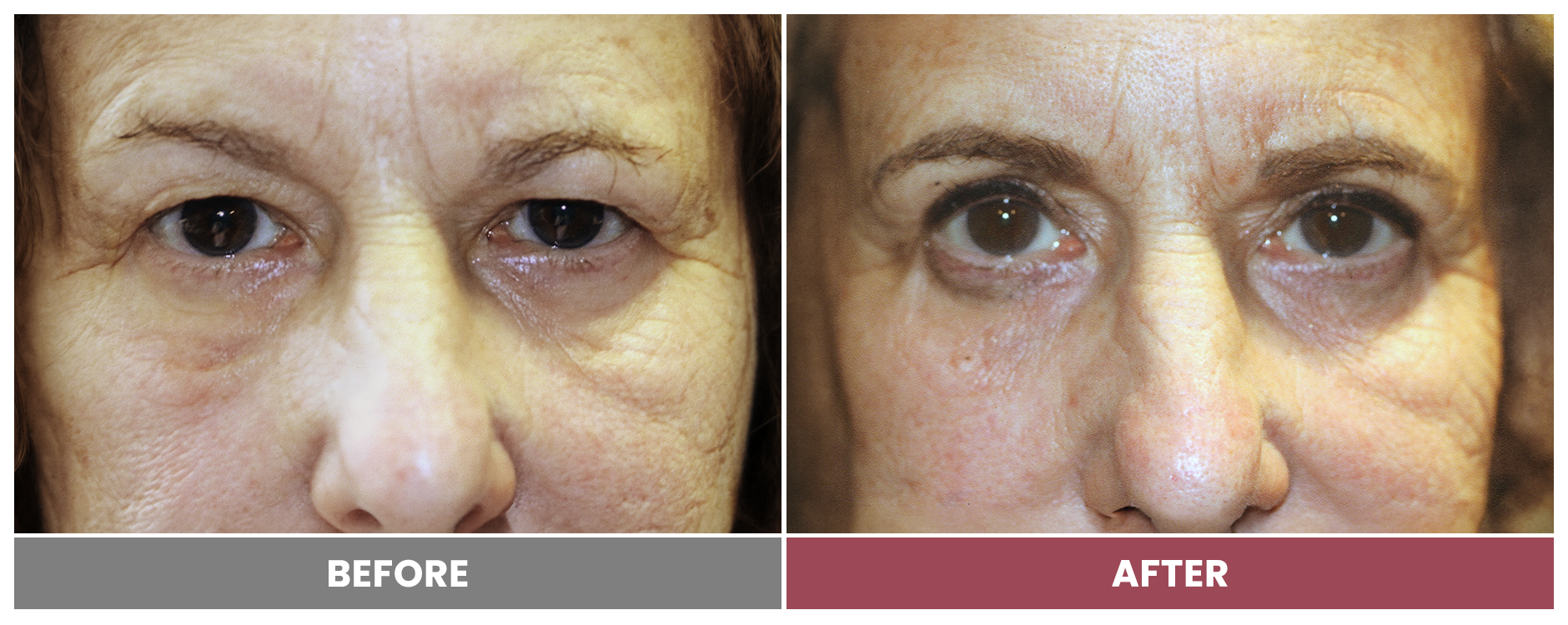 Upper Blepharoplasty - Case 7